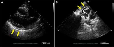 A Case of Acute Pericarditis After COVID-19 Vaccination